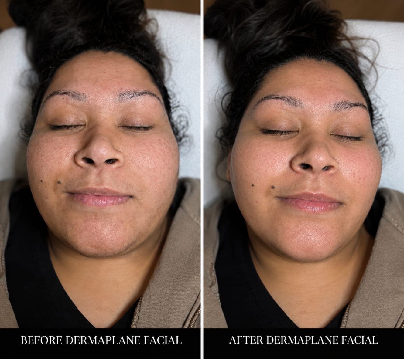 Before and after a Dermaplane Facial