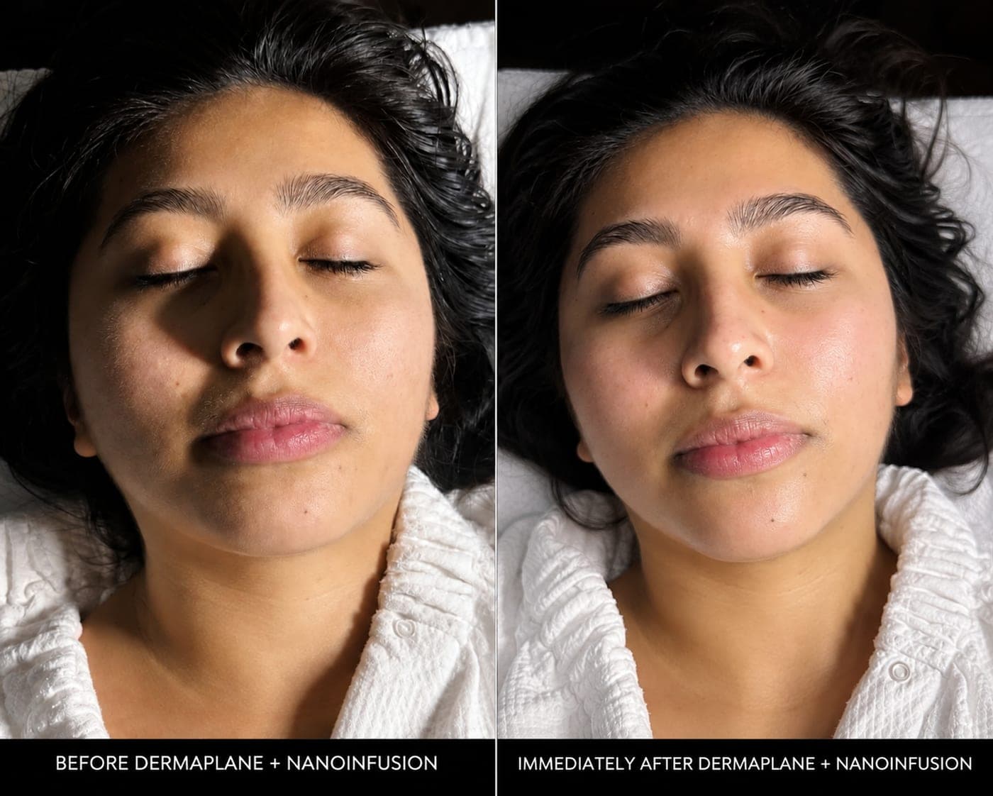 Before and immediately after Dermaplaning with Nano-Infusion