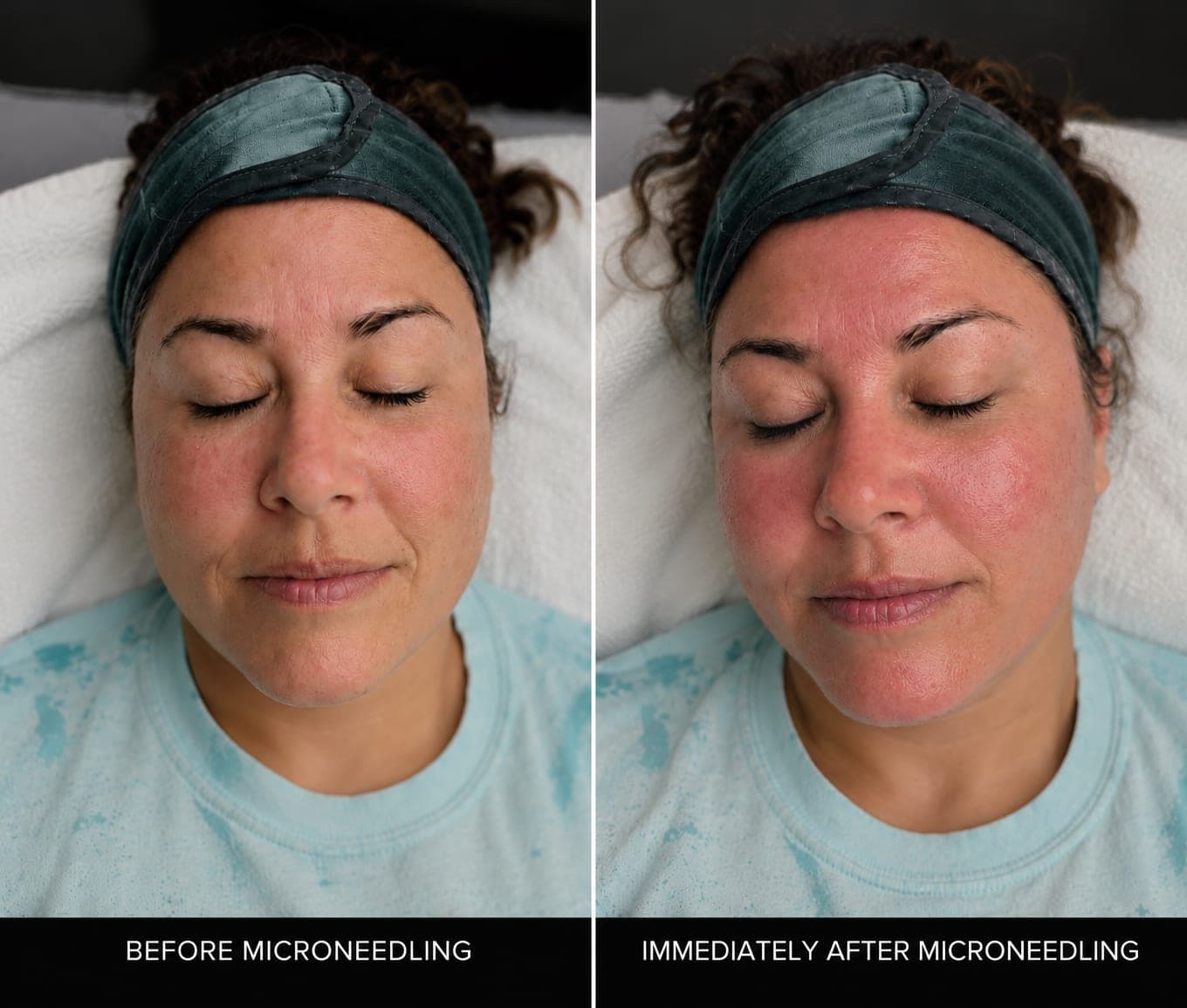 Before and immediately after a microneedling session