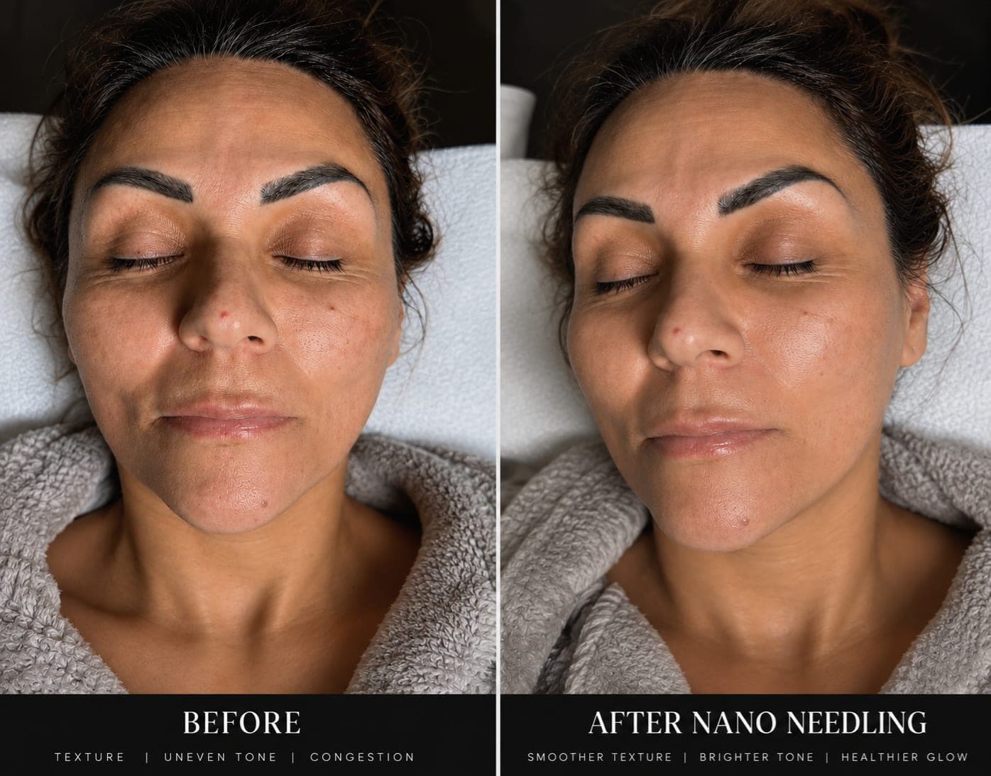 Before and after a Nano-Infusion facial