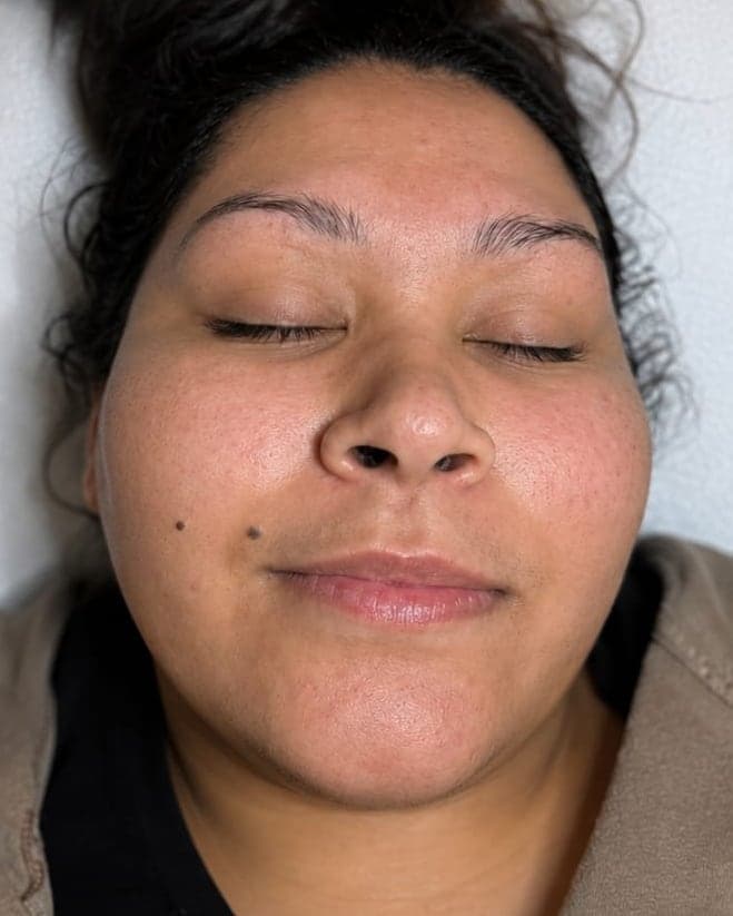 After: Dermaplane Facial