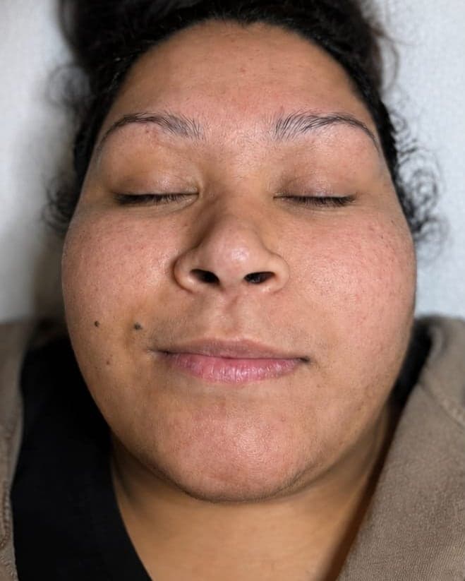 Before: Dermaplane Facial