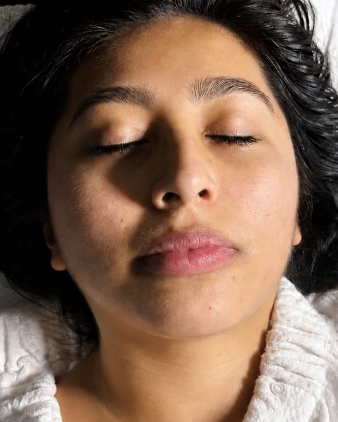 Before: Dermaplaning + Nano-Infusion