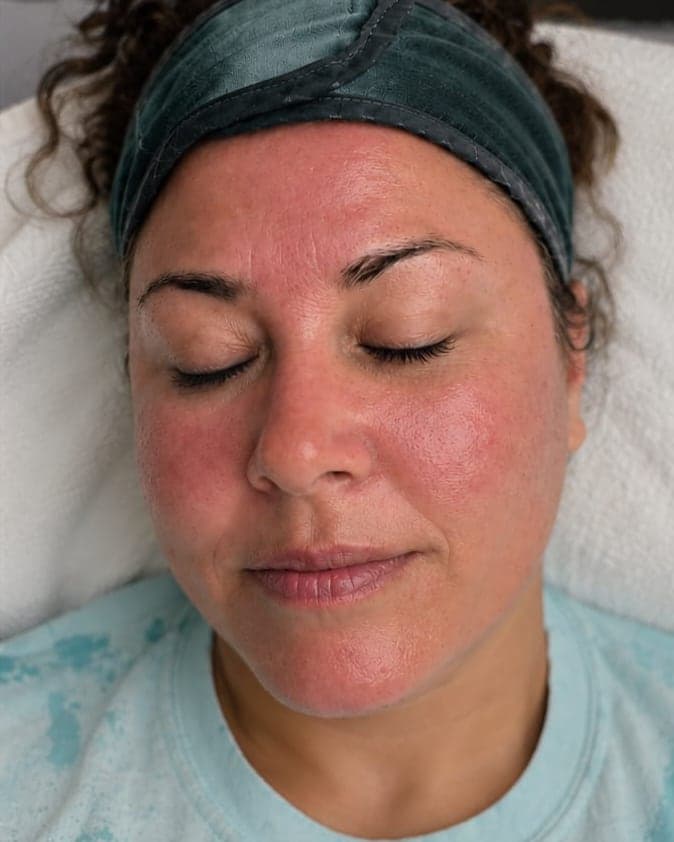 Immediately after: Microneedling