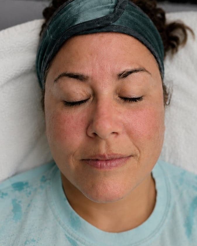 Before: Microneedling