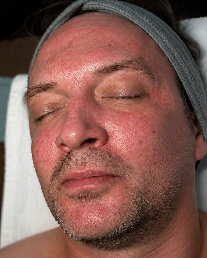 Immediately after: Microneedling