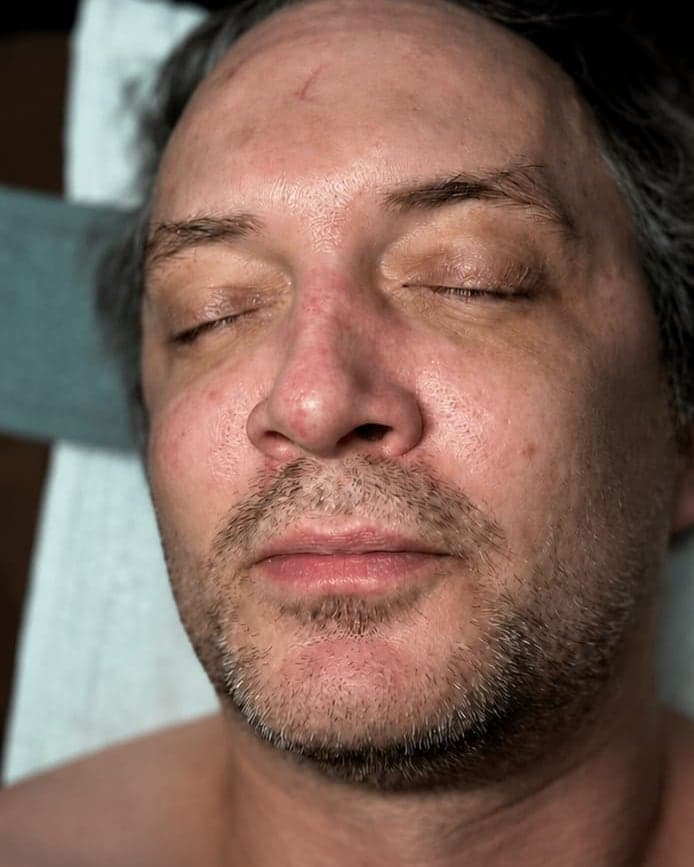 Before: Microneedling